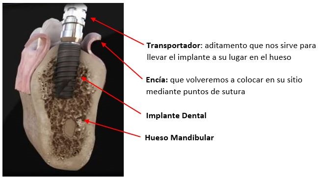 Implante dental
