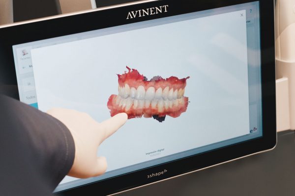 scaner intraoral (CAD CAM)