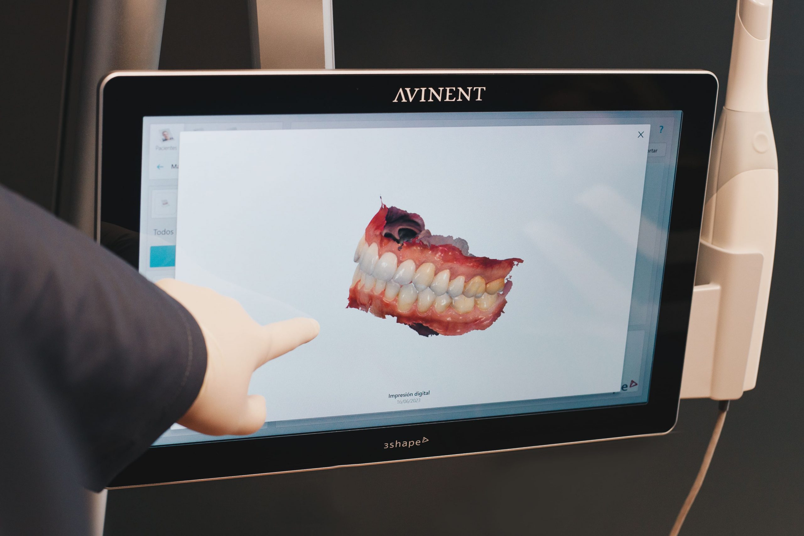 scaner intraoral (CAD CAM)