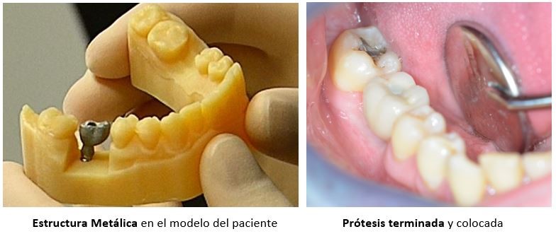 Implante dental