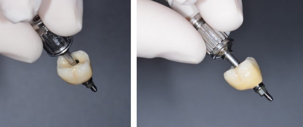 Implante dental