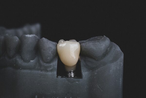 implantes dentales preguntas y respuestas