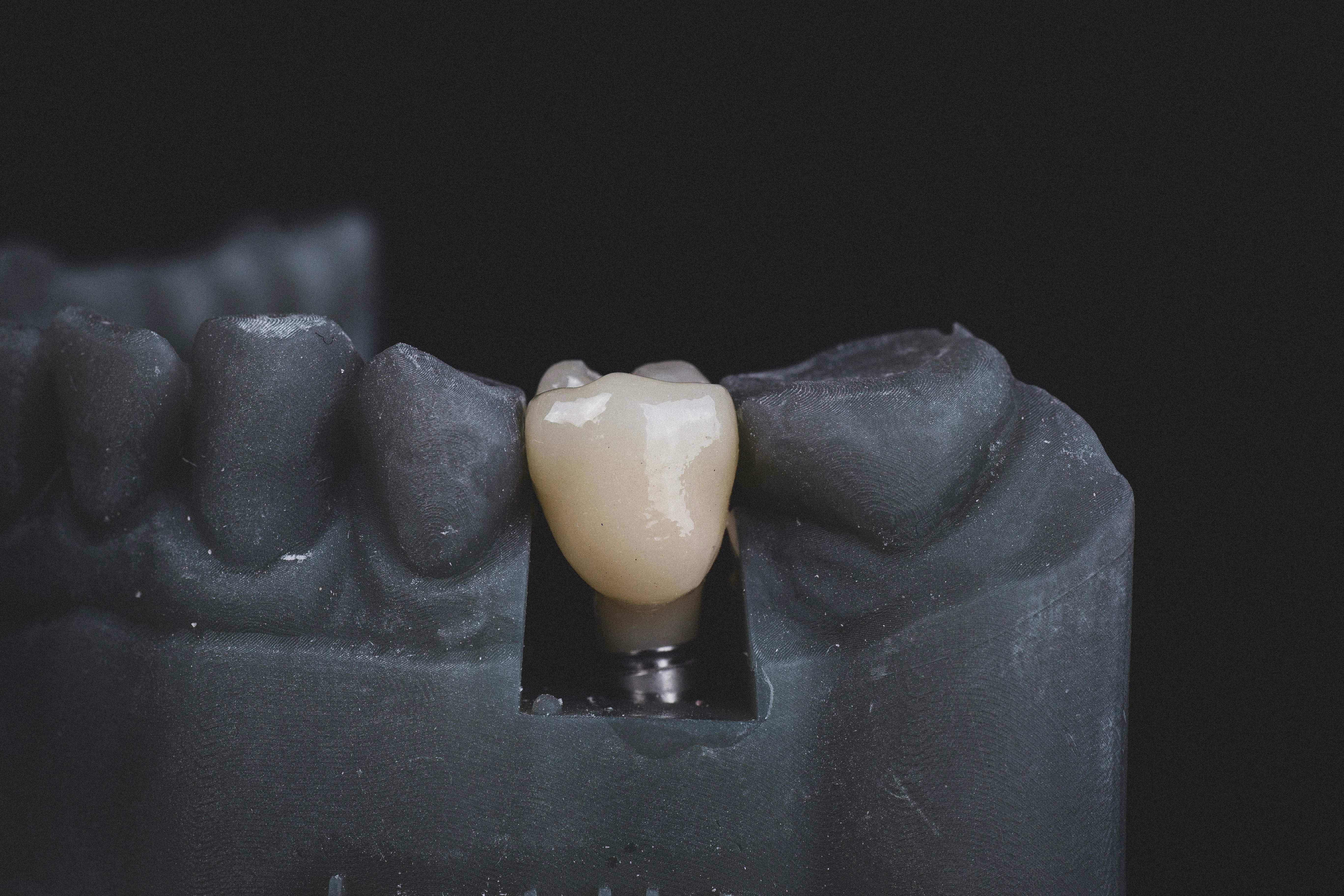 implantes dentales preguntas y respuestas