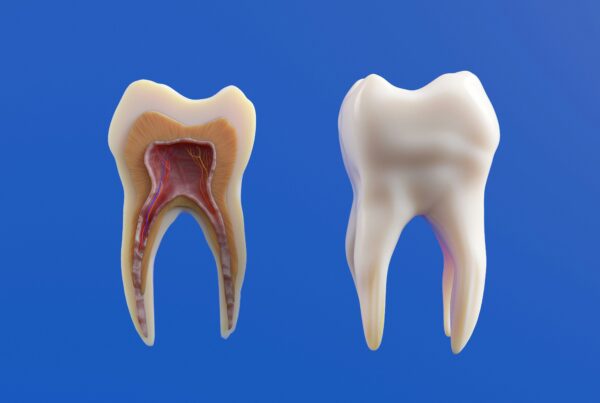 Preguntas frecuentes sobre endodoncia