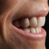 Cuánto dura un implante dental