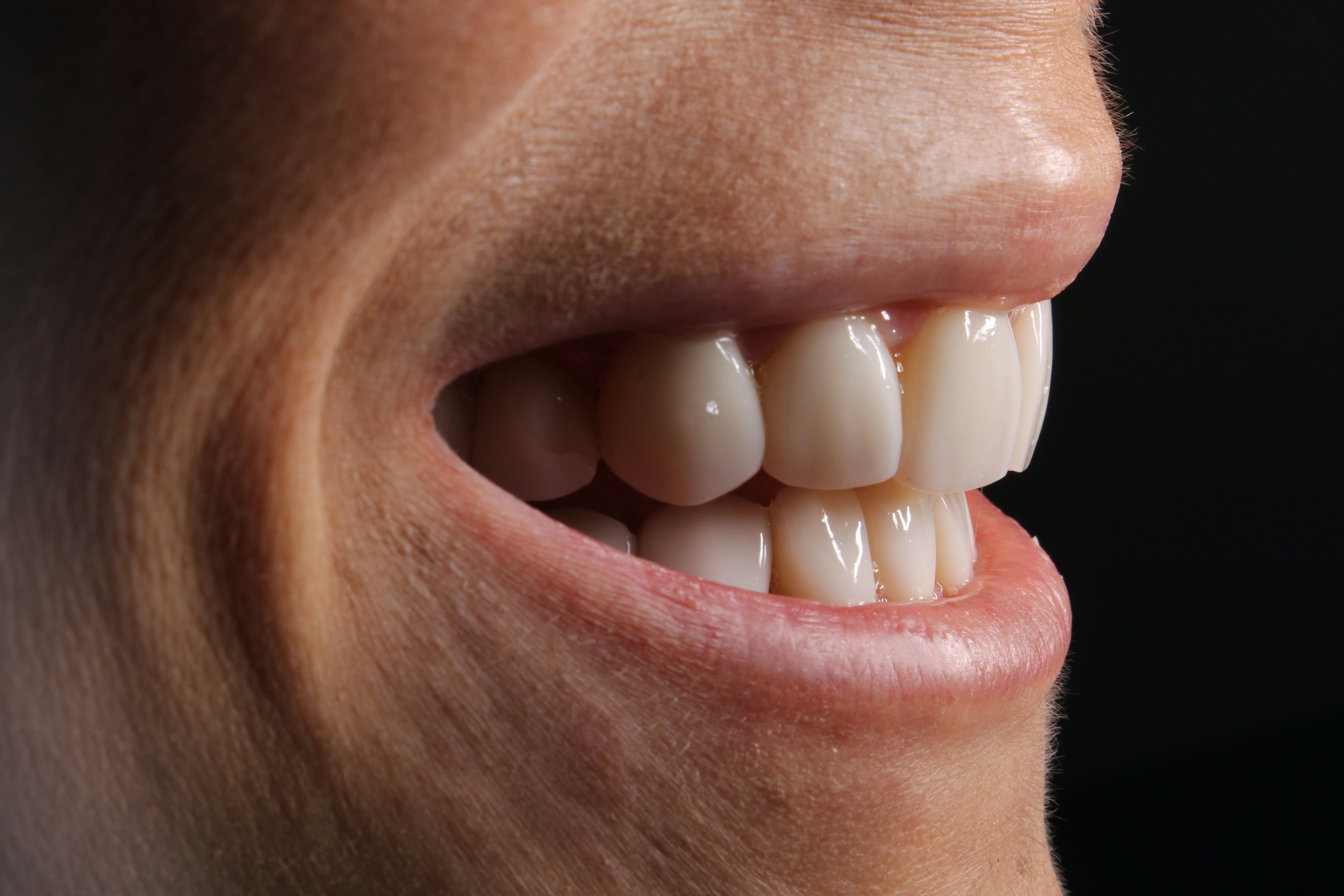 Cuánto dura un implante dental